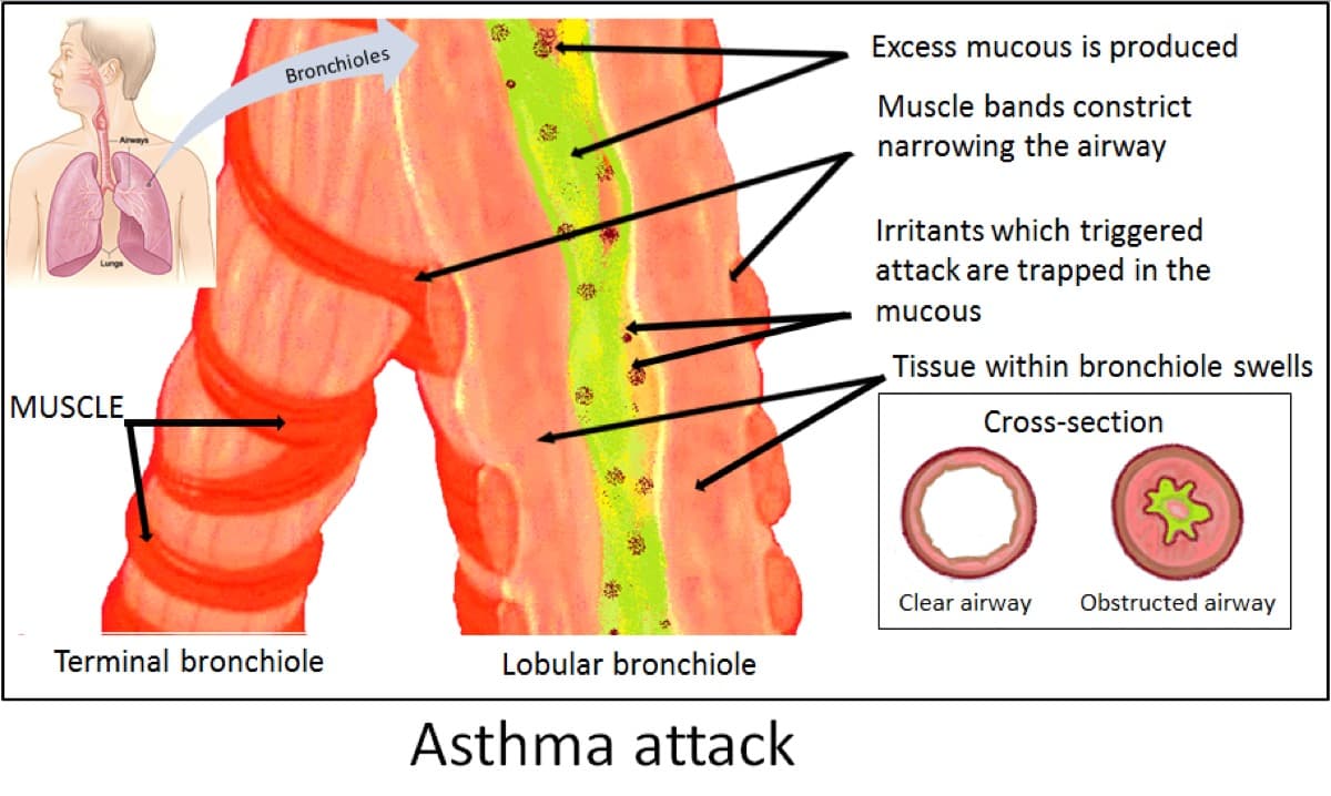 Diagram of an asthma attack showing bronchial tube constriction, mucus production, and reduced airflow compared to a normal airway