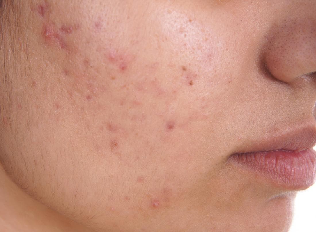 Close-up of acne breakouts on a cheek
