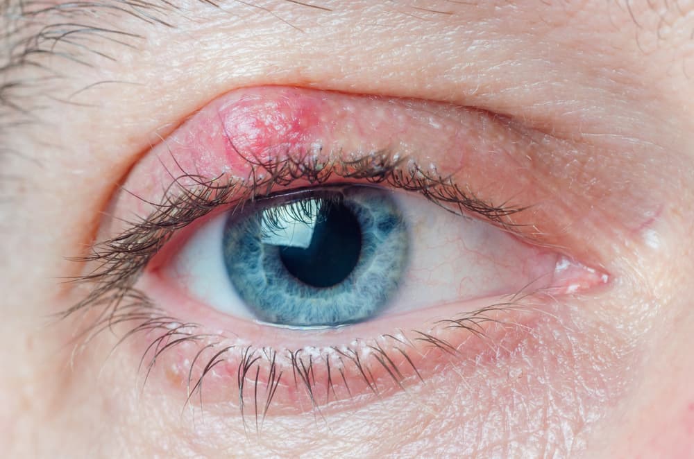 Close-up of an eyelid with a chalazion bump