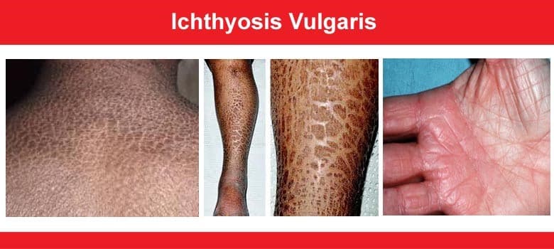 Close-up photos of dry, scaly skin typical of ichthyosis vulgaris