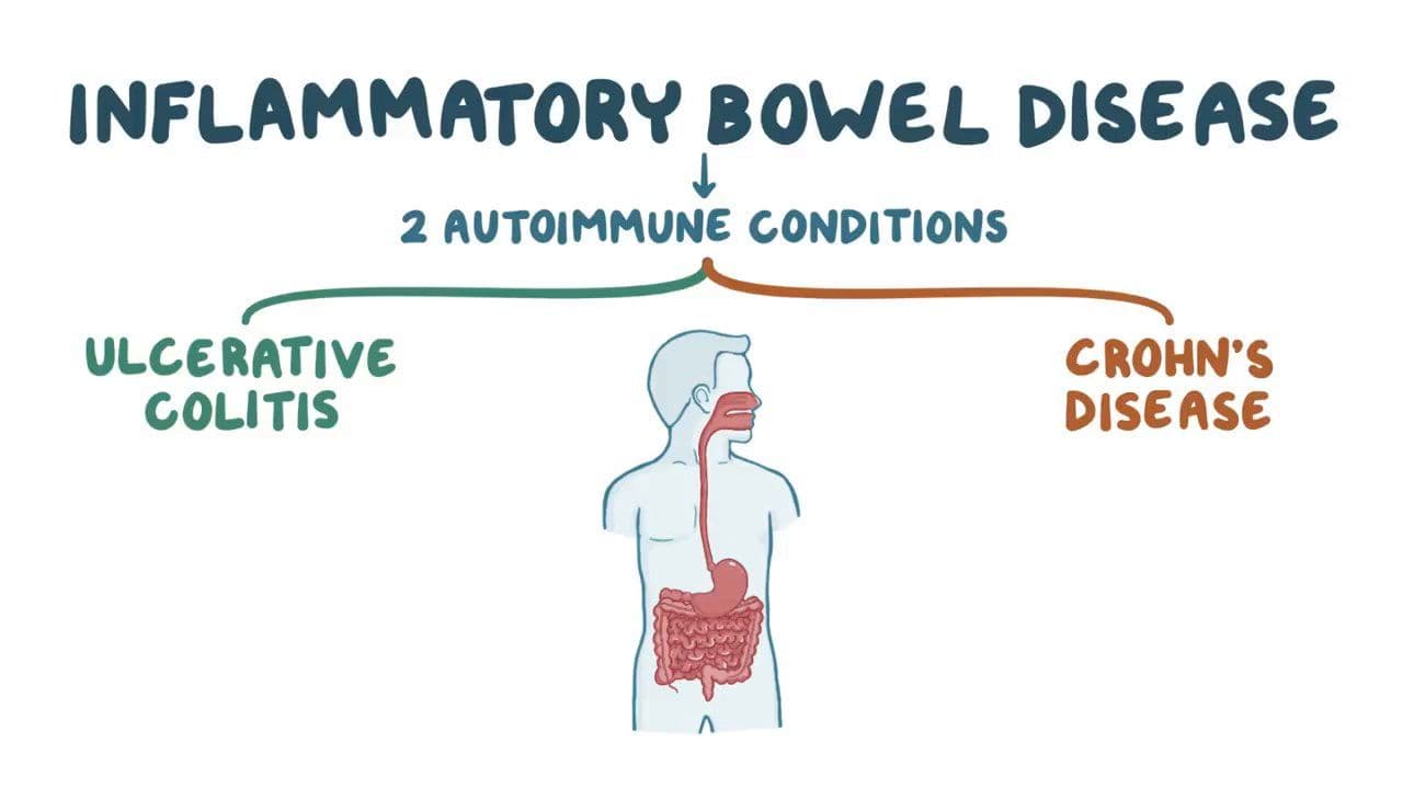 Illustration explaining ulcerative colitis and Crohn's disease as the two forms of inflammatory bowel disease
