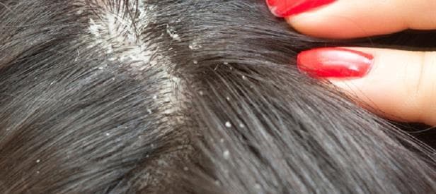 Close-up of flaking at the scalp hairline typical of seborrheic dermatitis