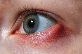 Close-up of an eye with a stye at the eyelid margin