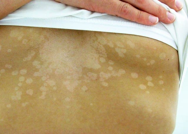 Pale patches on tanned skin typical of pityriasis versicolor