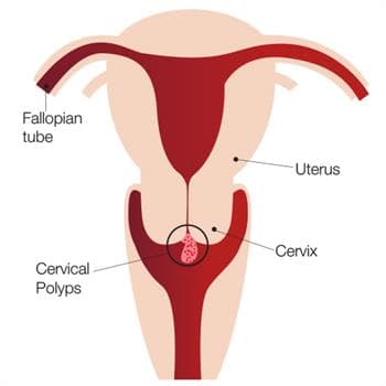 Diagram of the uterus and cervix showing the location of a cervical polyp