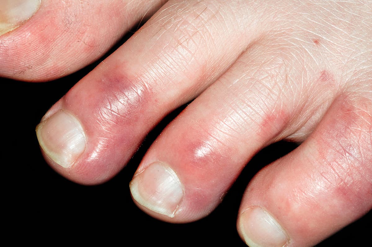 Close-up of toes showing the discolouration typical of chilblains
