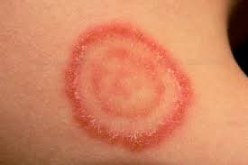Close-up of a ring-shaped fungal skin infection