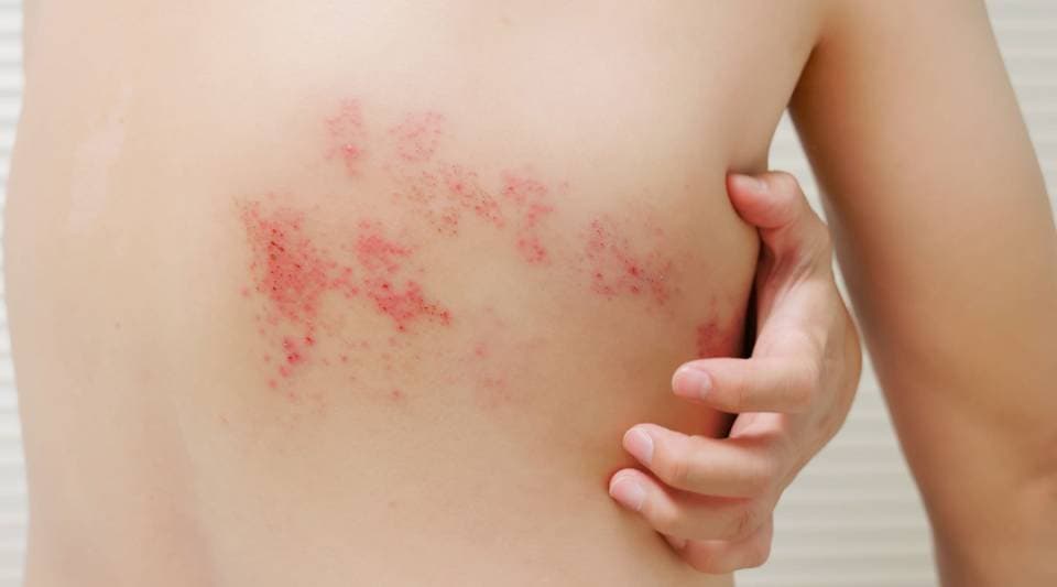 Close-up of a shingles rash on the torso