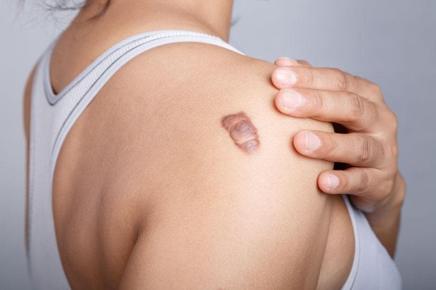Close-up of a keloid scar on the shoulder