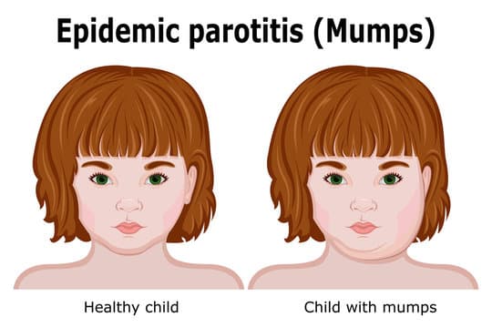 Illustration comparing a healthy child and a child with mumps