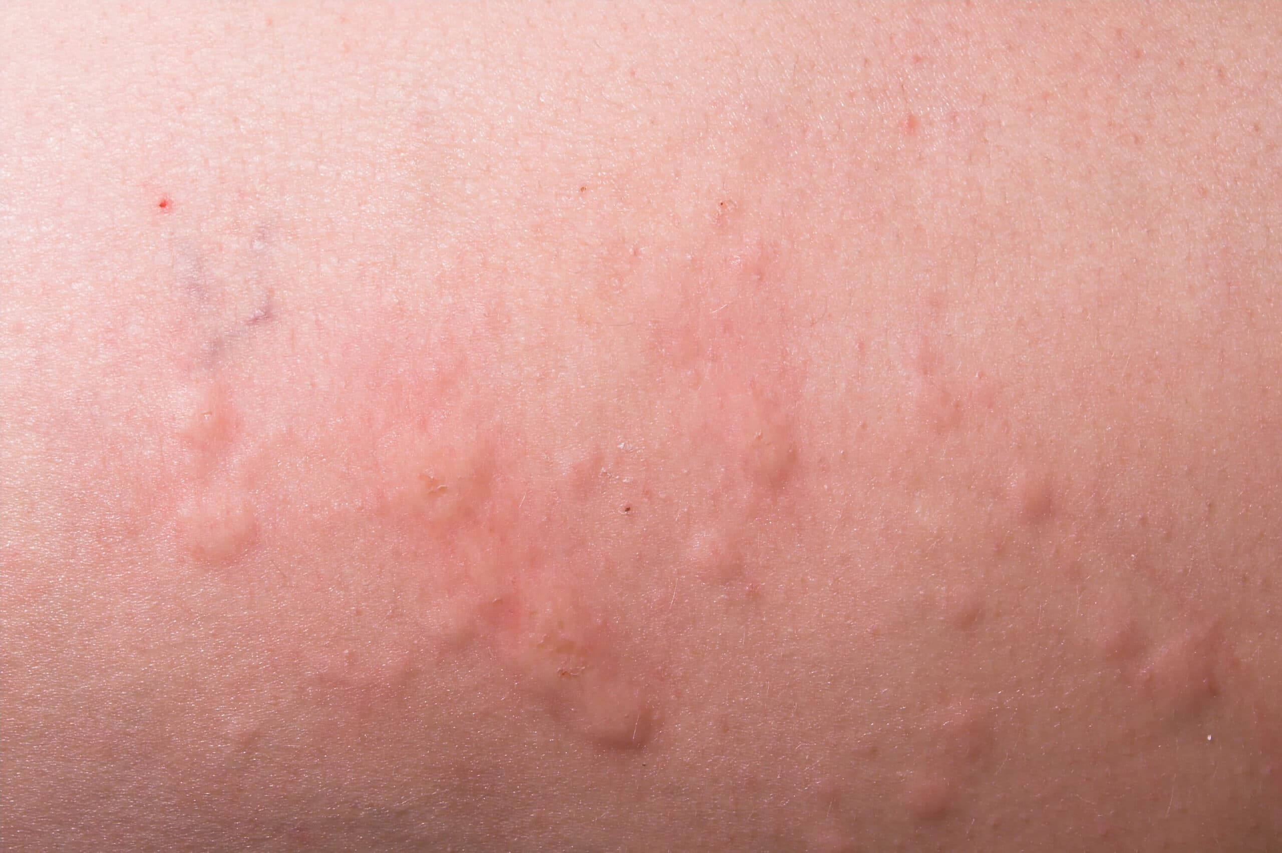 Close-up of a raised, itchy hives rash on skin
