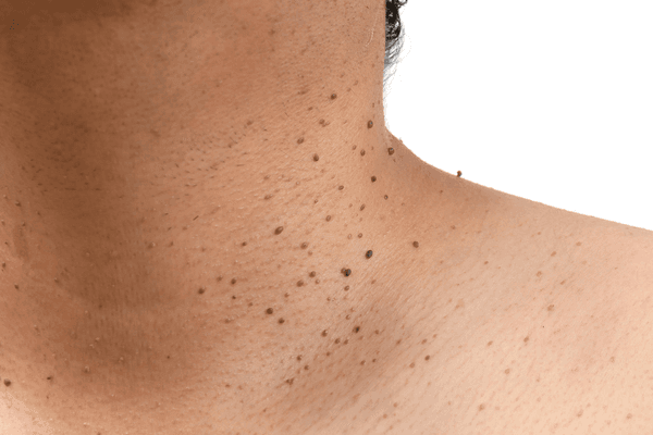 Close-up of small skin tags on the neck