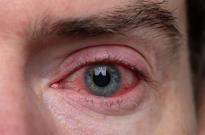 Close-up of an eye with red, swollen eyelid margins characteristic of blepharitis