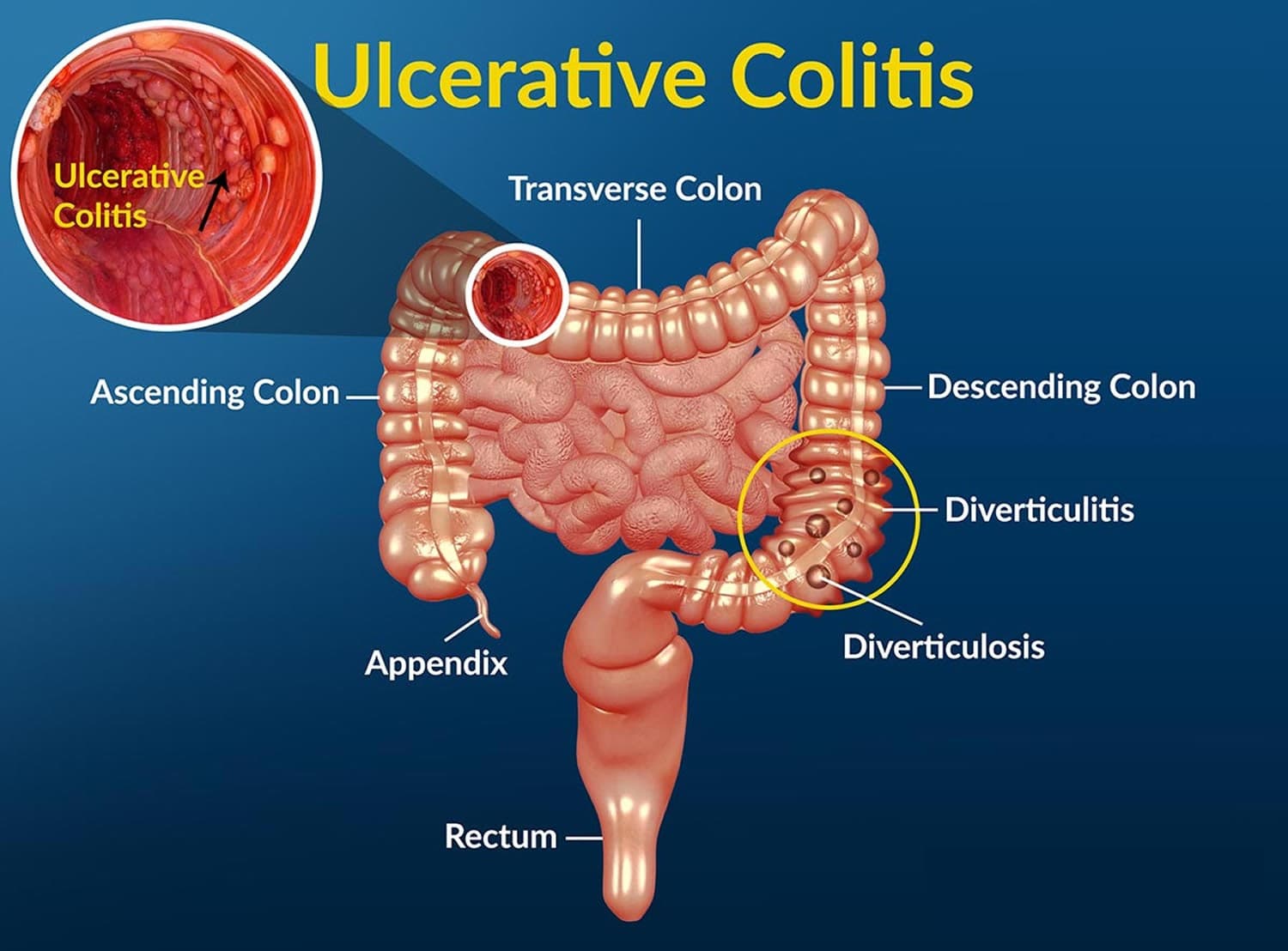 Diagram of the colon showing the areas affected by ulcerative colitis