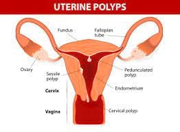 Diagram of the uterus showing the location of uterine polyps