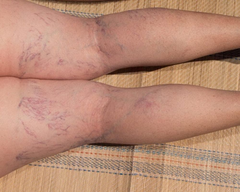 Close-up of varicose veins on the back of the legs
