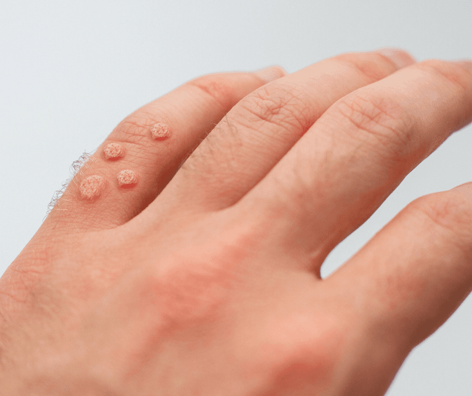 Close-up of warts on the back of a hand